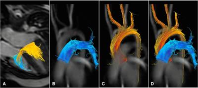 Assessment of 4D flow MRI for quantification of left-to-right shunt in pediatric patients with ventricular septal defect: comparison with right heart catheterization